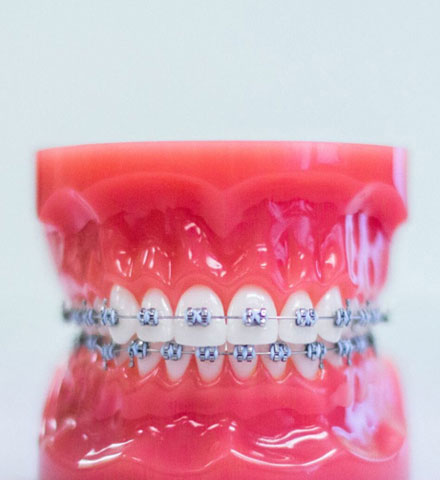 clear-aligners
